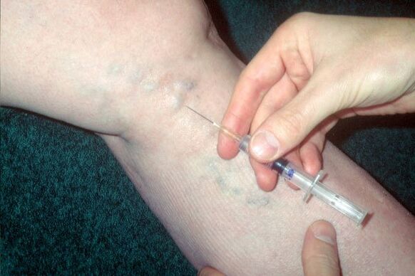 escleroterapia para varizes