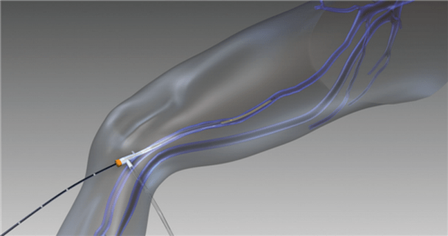 obliteração por radiofrequência para varizes