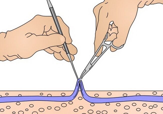remoção de veias para varizes
