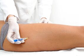 escleroterapia como método de tratamento de varizes