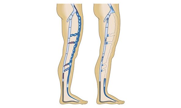 veias saudáveis ​​e doentes nas pernas